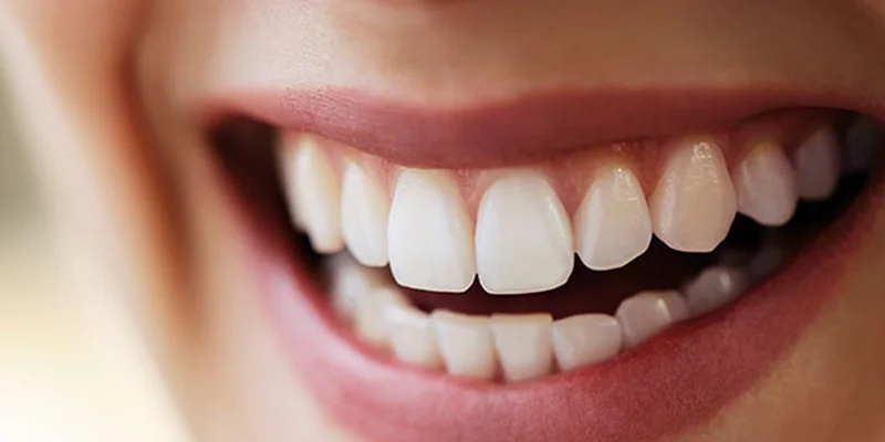 Diş Estetiği Nedir ve Hangi Sorunlar İçin Uygulanır?