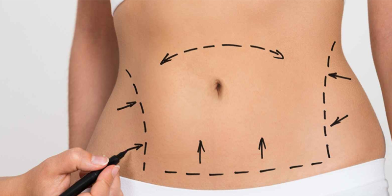 Karın Germe (Abdominoplasti) Nedir ve Kimler İçin Uygundur?